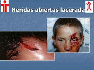Heridas abiertas laceradas
 