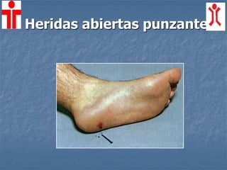 Heridas abiertas punzantes
 