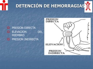 DETENCIÓN DE HEMORRAGIAS
 PRESION DIRECTA
 ELEVACION DEL
MIEMBRO
 PRESION INDIRECTA
 