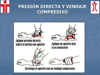 PRESIÓN DIRECTA Y VENDAJE
COMPRESIVO
 