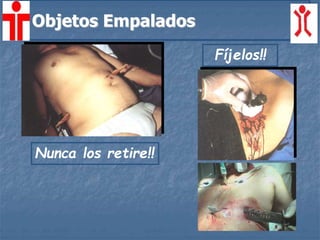 Fíjelos!!
Nunca los retire!!
Objetos Empalados
 