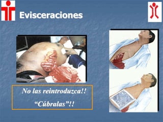 Evisceraciones
No las reintroduzca!!
“Cúbralas”!!
 