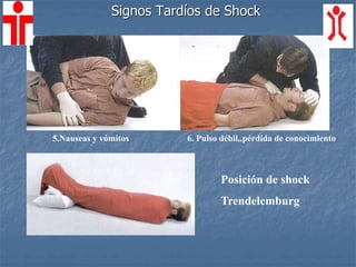 Signos Tardíos de Shock
5.Nauseas y vómitos 6. Pulso débil,,pérdida de conocimiento
Posición de shock
Trendelemburg
 