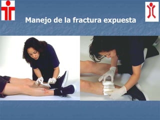 Manejo de la fractura expuesta
 