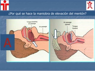 ¿Por qué se hace la maniobra de elevación del mentón?
A
 