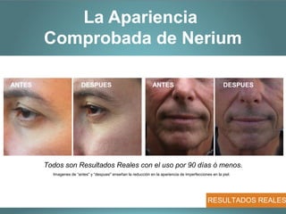 La Apariencia
        Comprobada de Nerium

ANTES                    DESPUES                                 ANTES                                   DESPUES




        Todos son Resultados Reales con el uso por 90 días ó menos.
          Imagenes de “antes" y “despues" enseñan la reducción en la apariencia de imperfecciones en la piel.




                                                                                                RESULTADOS REALES
 