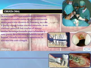 CIRUGÍA ORALSe encarga del tratamiento de terceros molares cuando estos se encuentran en mala posición dentro de hueso y no van a poder erupcionar correctamente, o en ciertos casos en los cuales el tercer molar ha erupcionado parcialmente y una parte de este esta retenido en el hueso, siendo necesaria entonces la extracción con cirugía.  