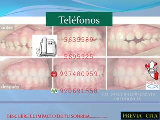 Utilice protectores bucales cuando practique deportes de riesgo.Secuencia de Erupción dentaria.