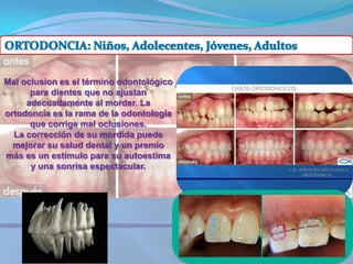 ORTODONCIA: Niños, Adolecentes, Jóvenes, Adultos Mal oclusion es el término odontológico para dientes que no ajustan adecuadamente al morder. La ortodoncia es la rama de la odontología que corrige mal oclusiones.La corrección de su mordida puede mejorar su salud dental y un premio más es un estímulo para su autoestima y una sonrisa espectacular.