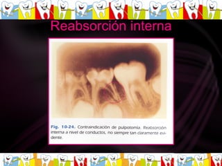 Reabsorción interna  