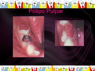 Pólipo Pulpar  
