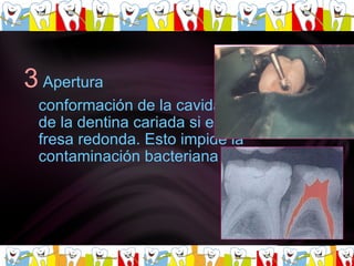 3   Apertura conformación de la cavidad y eliminación de la dentina cariada si existe. Con una fresa redonda. Esto impide la contaminación bacteriana pulpar. 