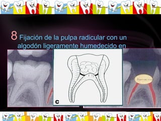 8   Fijación de la pulpa radicular con un algodón ligeramente humedecido en formocresol presionando ligeramente de 0.30-1 minuto   