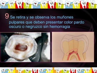 9   Se retira y se observa los muñones pulpares que deben presentar color pardo oscuro o negruzco sin hemorragia  