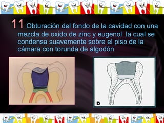 11   Obturación del fondo de la cavidad con una mezcla de oxido de zinc y eugenol  la cual se condensa suavemente sobre el piso de la cámara con torunda de algodón  