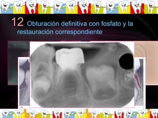 12  Obturación definitiva con fosfato y la restauración correspondiente 