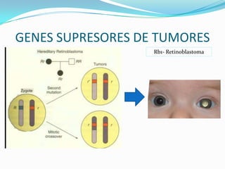 GENES SUPRESORES DE TUMORES
Rb1- Retinoblastoma
 
