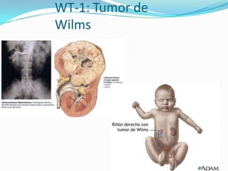 WT-1: Tumor de
Wilms
 