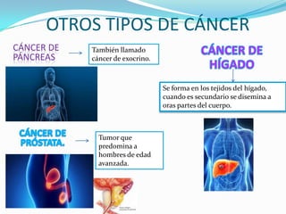 OTROS TIPOS DE CÁNCER
CÁNCER DE
PÁNCREAS
También llamado
cáncer de exocrino.
Tumor que
predomina a
hombres de edad
avanzada.
Se forma en los tejidos del hígado,
cuando es secundario se disemina a
oras partes del cuerpo.
 