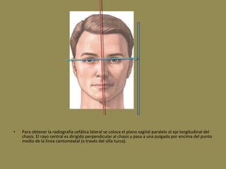 • Para obtener la radiografía cefálica lateral se coloca el plano sagital paralelo al eje longitudinal del
chasis. El rayo central es dirigido perpendicular al chasis y pasa a una pulgada por encima del punto
medio de la línea cantomeatal (a través del silla turca).
 