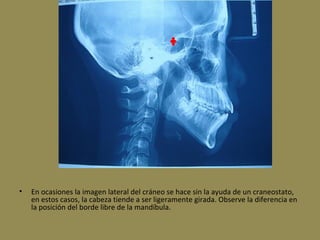 • En ocasiones la imagen lateral del cráneo se hace sin la ayuda de un craneostato,
en estos casos, la cabeza tiende a ser ligeramente girada. Observe la diferencia en
la posición del borde libre de la mandíbula.
 