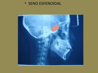 • SENO ESFENOIDAL
 