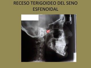 RECESO TERIGOIDEO DEL SENO
ESFENOIDAL
 