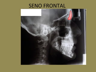 SENO FRONTAL
 