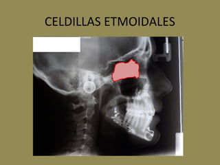 CELDILLAS ETMOIDALES
 