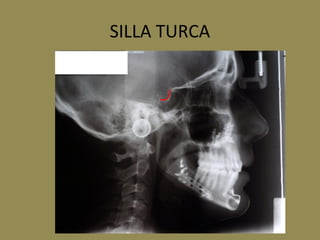 SILLA TURCA
 