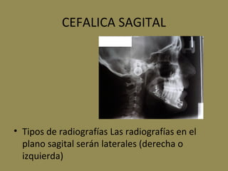 CEFALICA SAGITAL
• Tipos de radiografías Las radiografías en el
plano sagital serán laterales (derecha o
izquierda)
 