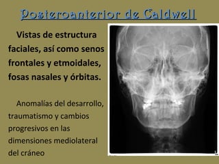 Posteroanterior de CaldwellPosteroanterior de Caldwell
Vistas de estructura
faciales, así como senos
frontales y etmoidales,
fosas nasales y órbitas.
Anomalías del desarrollo,
traumatismo y cambios
progresivos en las
dimensiones mediolateral
del cráneo
 