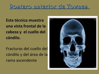 Postero anterior de TownesPostero anterior de Townes
Esta técnica muestra
una vista frontal de la
cabeza y el cuello del
cóndilo.
Fracturas del cuello del
cóndilo y del área de la
rama ascendente
 