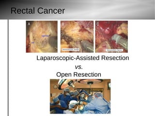Rectal Cancer
Laparoscopic-Assisted Resection
Open Resection
vs.
 
