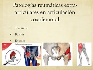 Patologías reumáticas extra- articulares en articulación coxofemoral 
•Tendinitis 
•Bursitis 
•Entesitis  
