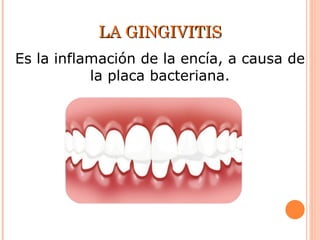 LA GINGIVITIS Es la inflamación de la encía, a causa de la placa bacteriana. 