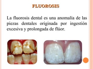 FLUOROSIS La fluorosis dental es una anomalía de las piezas dentales originada por ingestión excesiva y prolongada de flúor. 