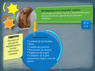 Cuidado de las heridas
Baño
Cambio de posición
Prevención de ulceras
Vigilancia de la piel
Cuidados de la piel:
tratamiento tópico, zona de
injerto
 