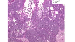 Nódulo pectoral
HE 100X
 