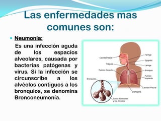 Las enfermedades mas
        comunes son:
 Neumonía:
 Es una infección aguda
 de      los      espacios
 alveolares, causada por
 bacterias patógenas y
 virus. Si la infección se
 circunscribe      a   los
 alvéolos contiguos a los
 bronquios, se denomina
 Bronconeumonía.
 