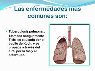 Las enfermedades mas
         comunes son:

 Tuberculosis pulmonar:
 Llamada antiguamente
 Tisis, es causada por el
 bacilo de Koch, y se
 propaga a través del
 aire, por la tos y el
 estornudo.
 