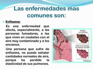 Las enfermedades mas
          comunes son:
 Enfisema:
 Es una enfermedad que
 afecta, especialmente, a las
 personas fumadoras, a las
 que viven en ciudades con el
 aire muy contaminado y a los
 ancianos.
 Una persona que sufre de
 enfisema, no puede exhalar
 cantidades normales de aire,
 porque     ha   perdido   la
 elasticidad de sus pulmones.
 