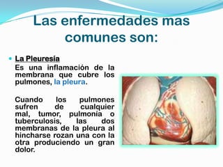 Las enfermedades mas
          comunes son:
 La Pleuresía
 Es una inflamación de la
 membrana que cubre los
 pulmones, la pleura.

 Cuando     los   pulmones
 sufren    de     cualquier
 mal, tumor, pulmonía o
 tuberculosis,   las   dos
 membranas de la pleura al
 hincharse rozan una con la
 otra produciendo un gran
 dolor.
 