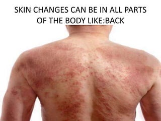SKIN CHANGES CAN BE IN ALL PARTS
OF THE BODY LIKE:BACK