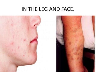 IN THE LEG AND FACE.