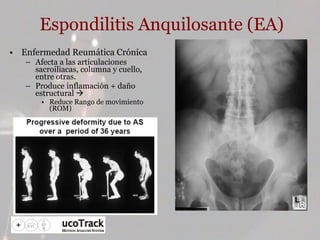 Espondilitis Anquilosante (EA) Enfermedad Reumática Crónica Afecta a las articulaciones sacroiliacas, columna y cuello, entre otras. Produce inflamación + daño estructural   Reduce Rango de movimiento (ROM) 