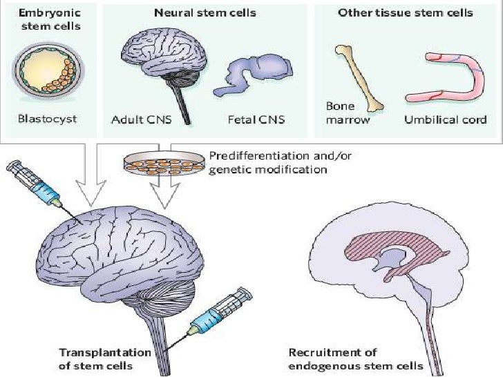 Stem Cells in the Treatment of Alzheimer's Disease