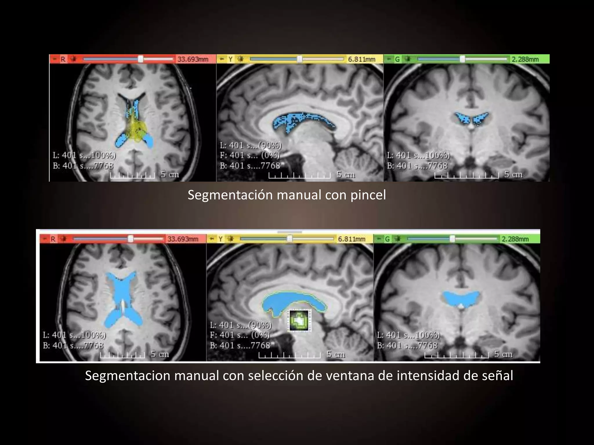 Segmentación manual con pincel
Segmentacion manual con selección de ventana de intensidad de señal
 