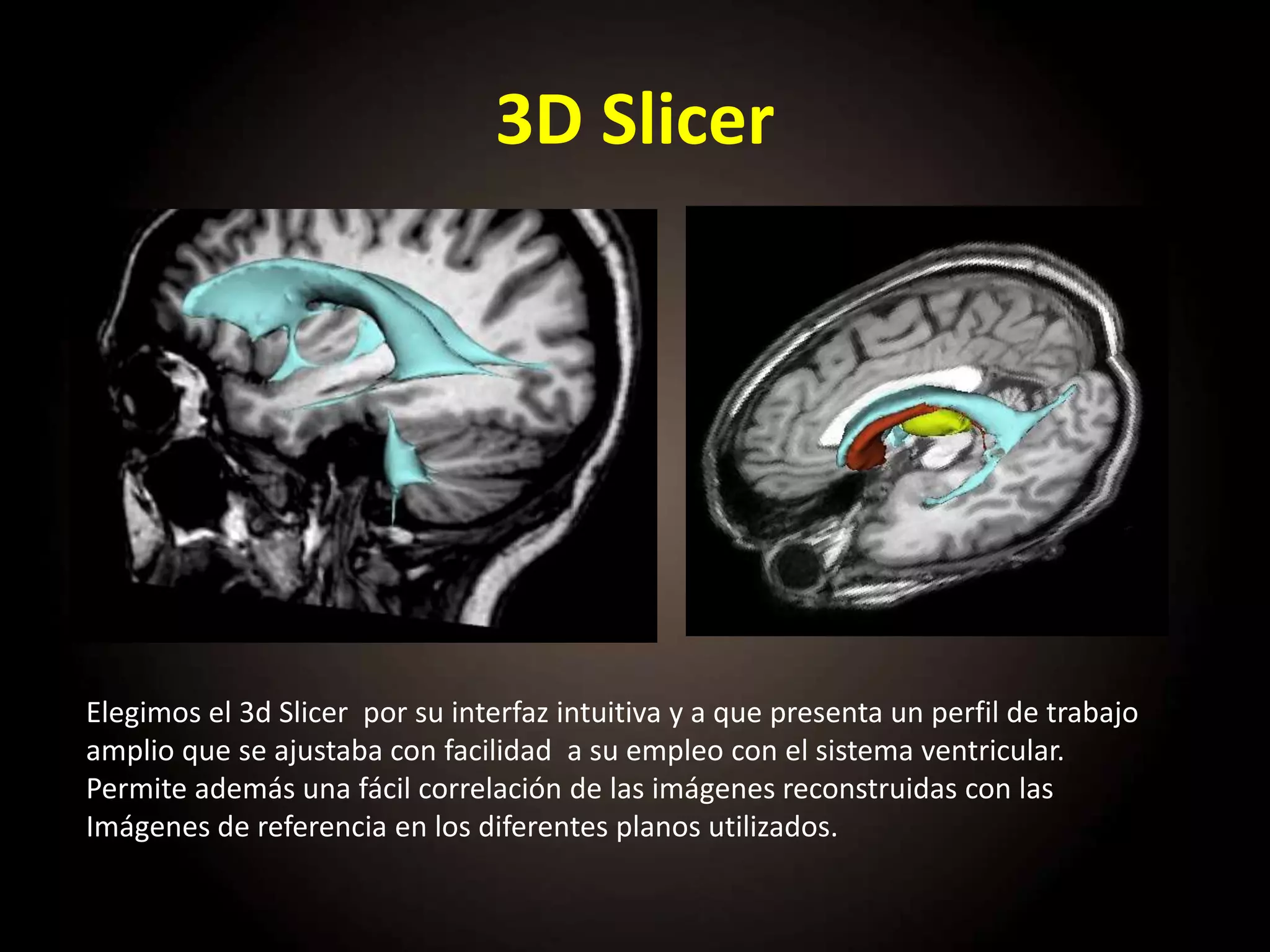 3D Slicer
Elegimos el 3d Slicer por su interfaz intuitiva y a que presenta un perfil de trabajo
amplio que se ajustaba con facilidad a su empleo con el sistema ventricular.
Permite además una fácil correlación de las imágenes reconstruidas con las
Imágenes de referencia en los diferentes planos utilizados.
 