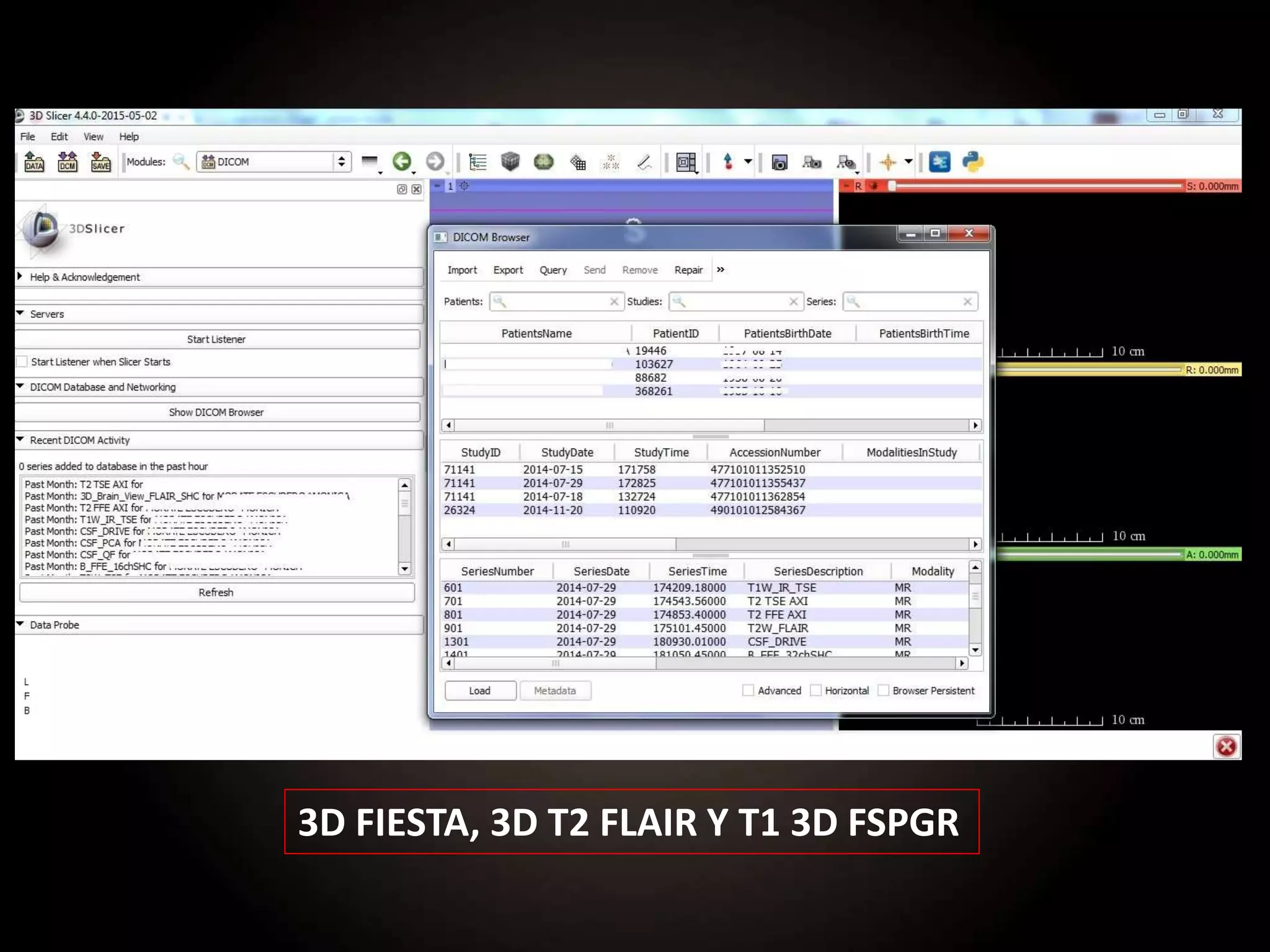3D FIESTA, 3D T2 FLAIR Y T1 3D FSPGR
 